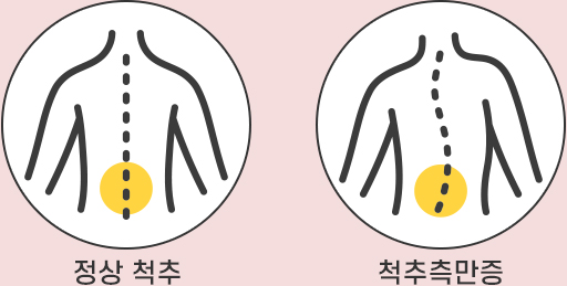 정상 척추,척추측만증을